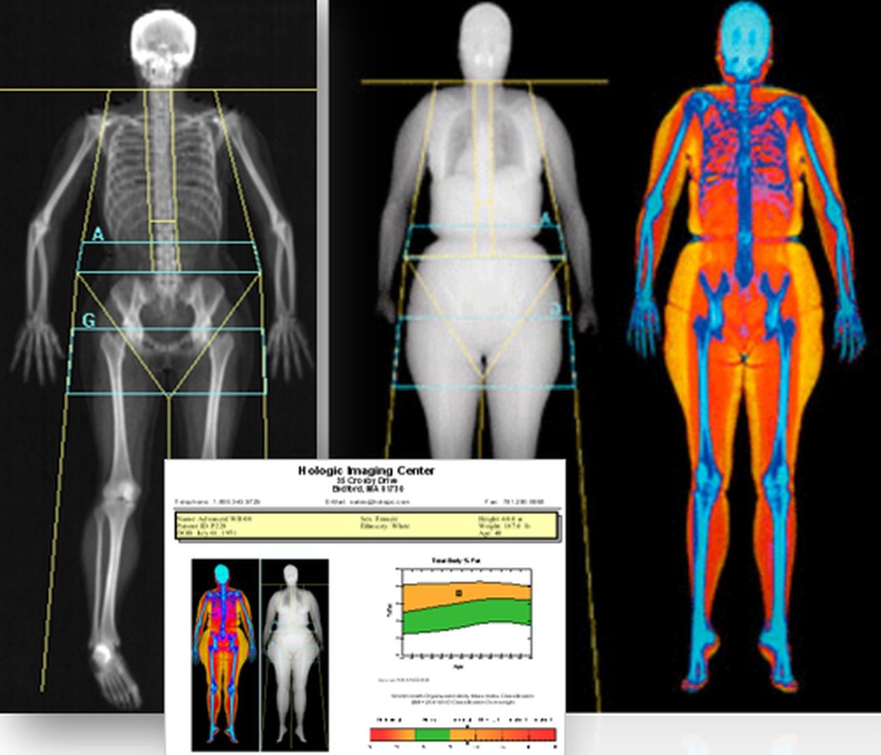 dexa5.jpg